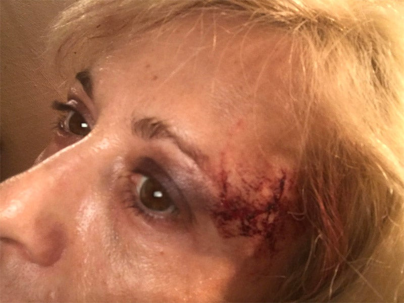 Η χορεύτρια Αλεξάνδρα Φωτεινού για τον ξυλοδαρμό της: «Με βούτηξε και άρχισε να με γρονθοκοπεί» (εικόνες)